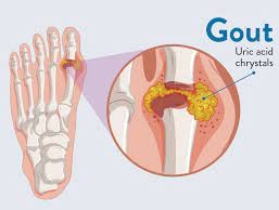 Gout | All Product Reviews 